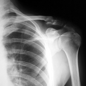 Figura 1 - Radiografia de um ombro humano.